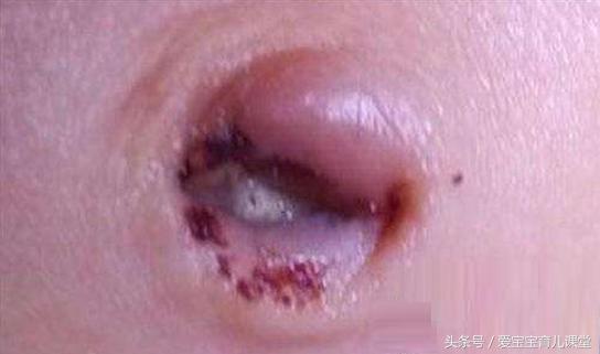 Hãy chăm sóc cuống rốn của trẻ sơ sinh cẩn thận và đúng phương pháp