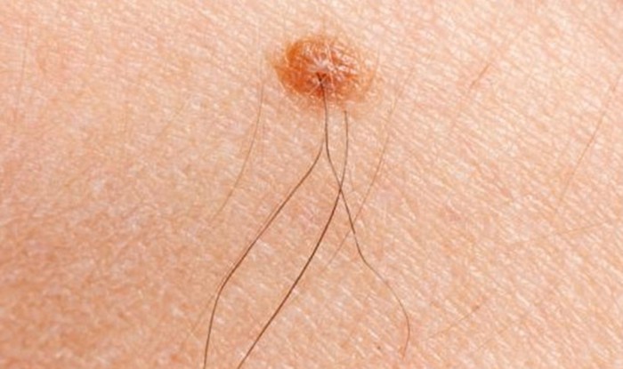 Vị trí nốt ruồi được thần tài gõ cửa