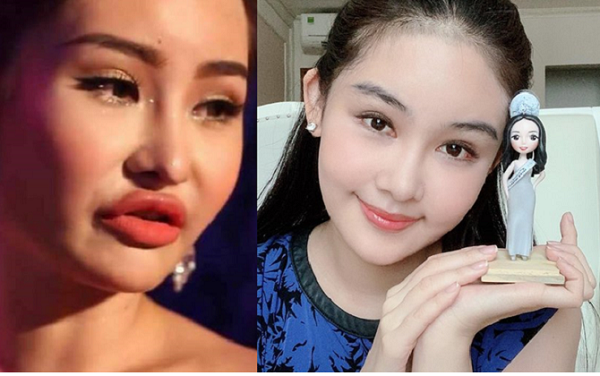 phau-thuat-tham-my-le-au-ngan-anh-1
