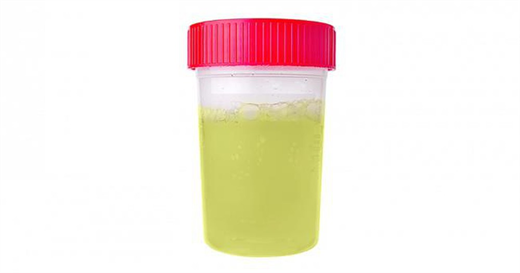 Đoán bệnh qua màu sắc nước tiểu