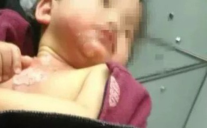 Mẹ có thể giúp con bằng các bước sơ cứu đúng cách