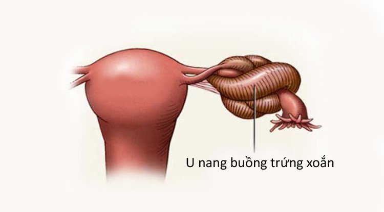 Phụ nữ cần lưu ý những dấu hiệu u nang buồng trứng để có thể điều trị kịp thời