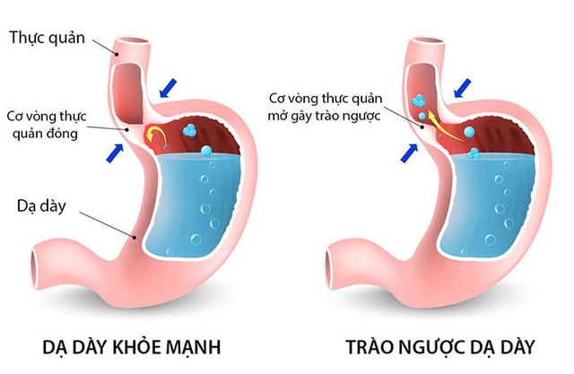 Hình ảnh minh họa về hiện tượng trào ngược thực quản Shbet123 Link Vào ShBet Mới Nhất ở trẻ
