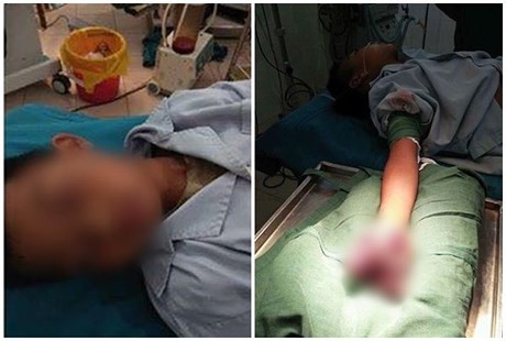 Một bệnh nhi bị dập nát bàn tay vì vừa chơi vừa sạc pin điện thoại.