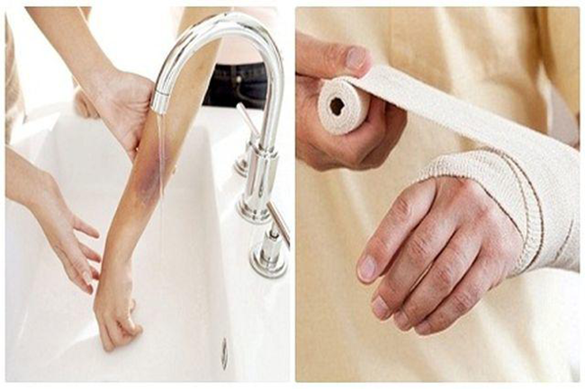 Khi con bị bỏng cần xả nước mát cho bé