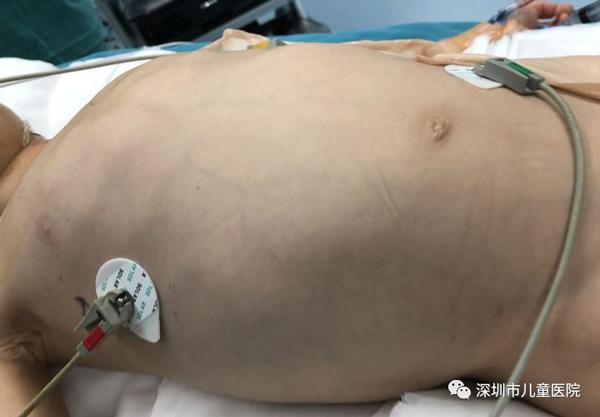 Bé trai 4 tuổi và khối u khổng lồ