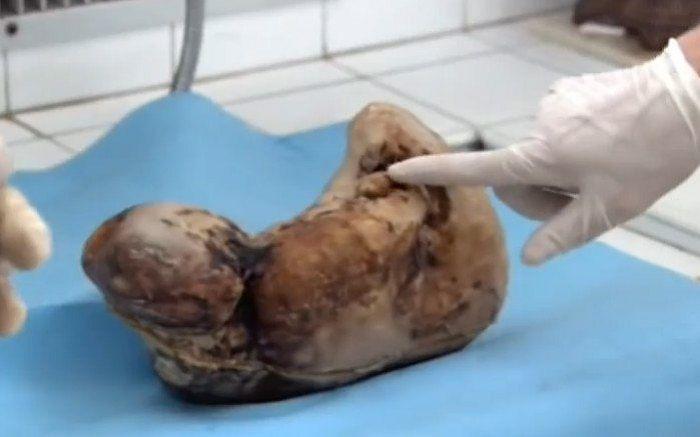 Thai nhi đã hóa đá sau 46 năm người mẹ mang trong bụng