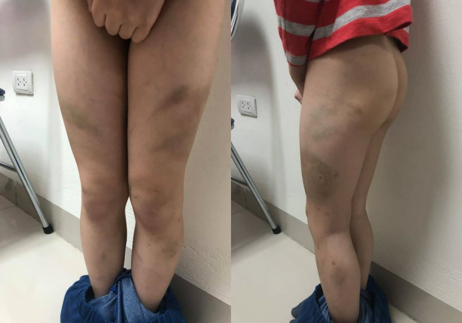 Bé trai bị bố bạo hành thâm tím khắp Sh88bet đăng ký miễn phí. 