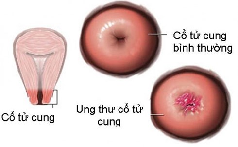 ung_thu_co_tu_cung_s