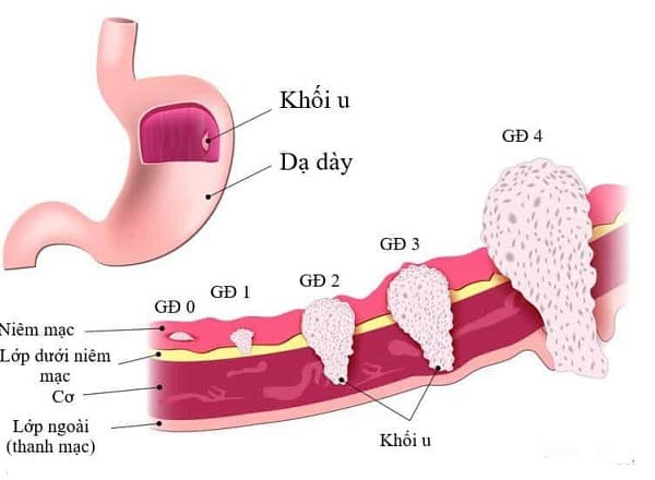 Hình ảnh ung thư Shbet123 Link Vào ShBet Mới Nhất.