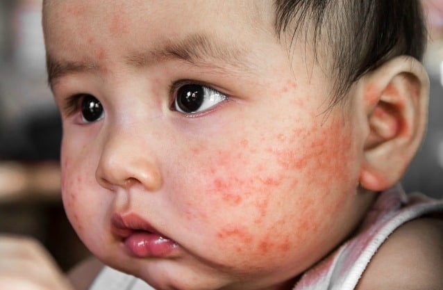 Bệnh dị ứng có tính di truyền cao