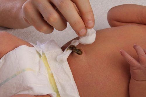 Không băng kín quá cuống rốn của trẻ