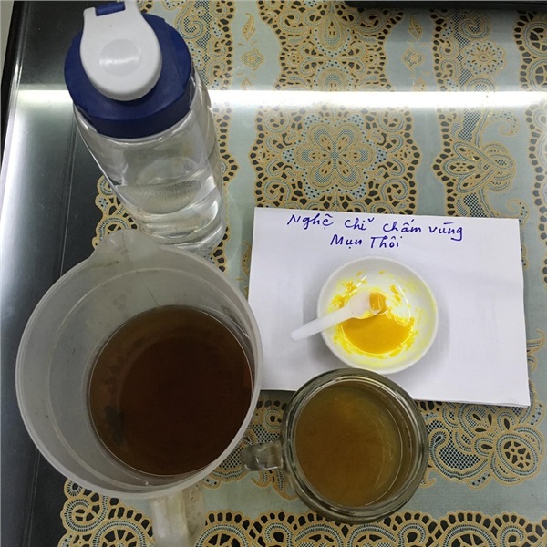 Mẹ lại tìm công thức trị mụn bằng nghệ cho con gái.