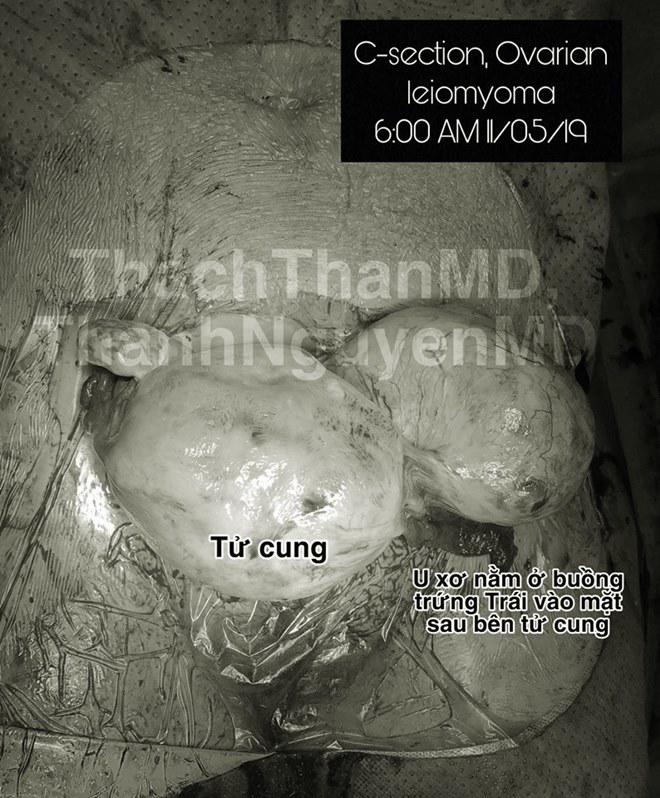 Khối u bác sĩ mổ trong người bệnh nhân