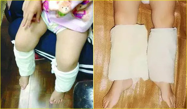 Buộc khăn vào bắp chân khi con sốt cao giúp hạ nhiệt nhanh