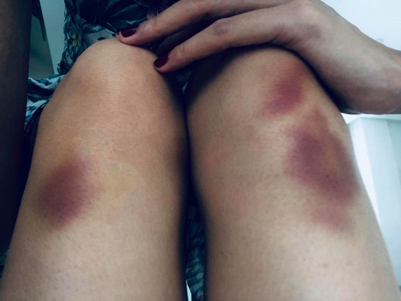 Mới đây, bà xã của cựu tuyển thủ Lê Công Vinh đăng bức ảnh đôi chân bầm dập, thâm tím vì tập luyện khiến fan xót xa. Không những thế, Thủy Tiên còn tiết lộ mình bị chấn thương ở lưng, nằm không được đi cũng không xong.    
