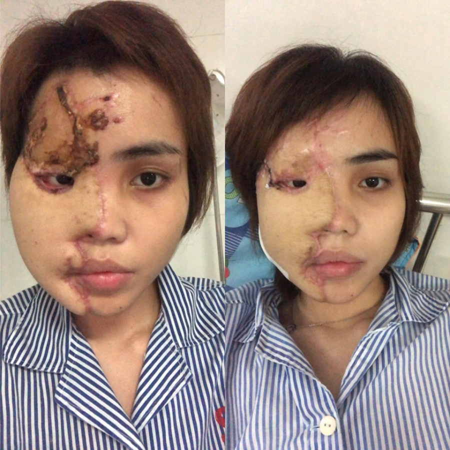 Hình ảnh chị V. bị biến dạng vì bị chồng sắp cưới tạt a xít.
