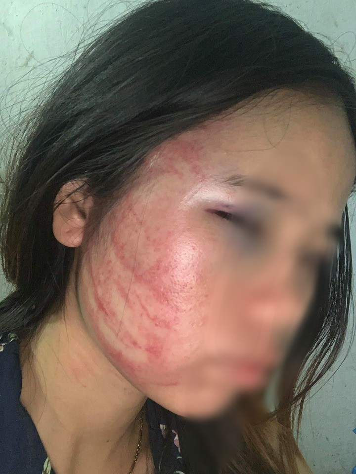 Khuôn mặt sưng tấy của cô vợ bầu trong câu chuyện.