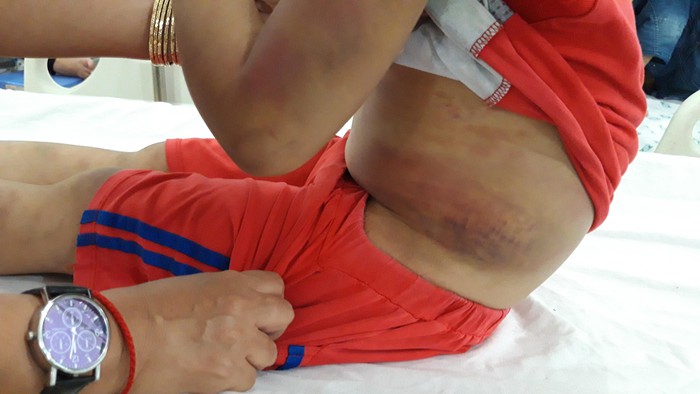 Vết thương bên hông bé trai khá nghiêm trọng - Ảnh: Giang Phương