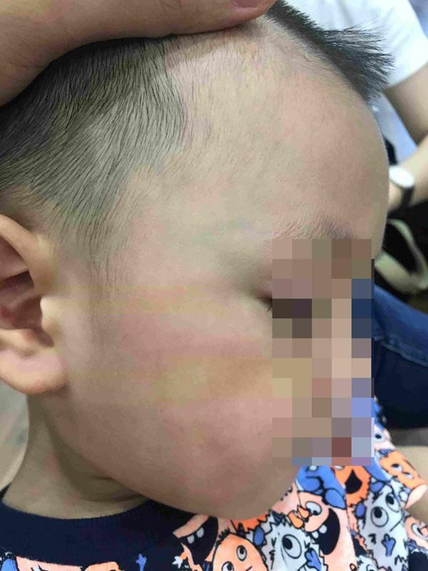 Bé trai bị cô giáo bạo hành.