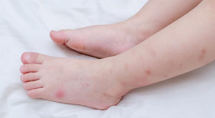 Trẻ bị côn trùng cắn cần phải được xử lý