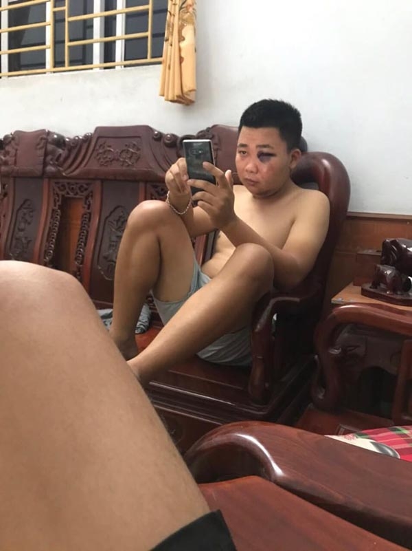 Một bên mắt sưng húp của chú rể tương lai.