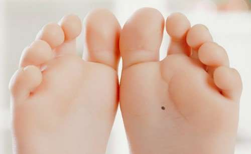 Nốt ruồi lòng bàn chân may mắn