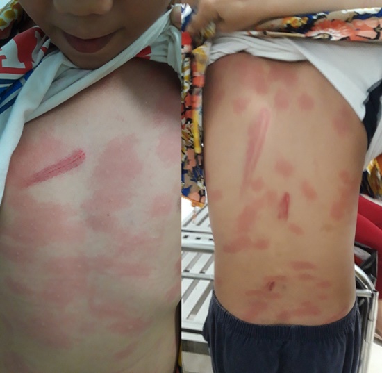 Bé trai bị cô ruột bạo hành.