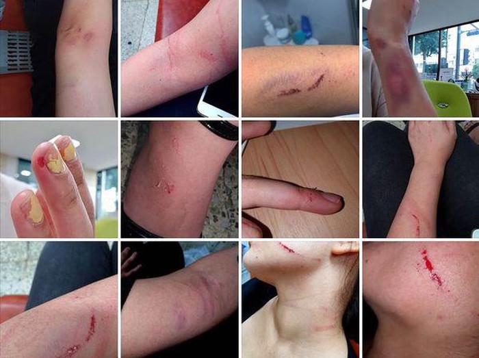 Cô gái trẻ với thương tích khắp người.