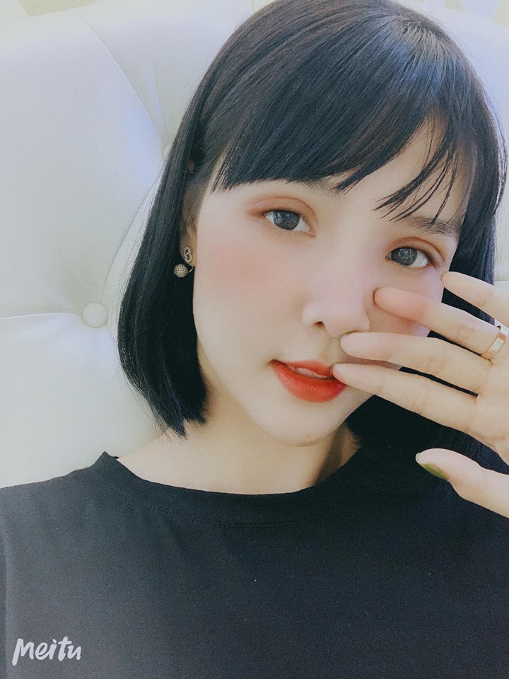 Kỳ Hân đã rút chỉ, mắt còn sưng sau khi cắt mí.    