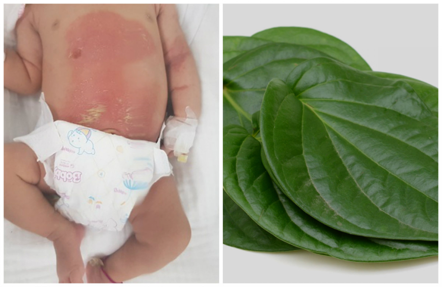 Bé L bị bỏng do dùng trầu không trị chướng bụng