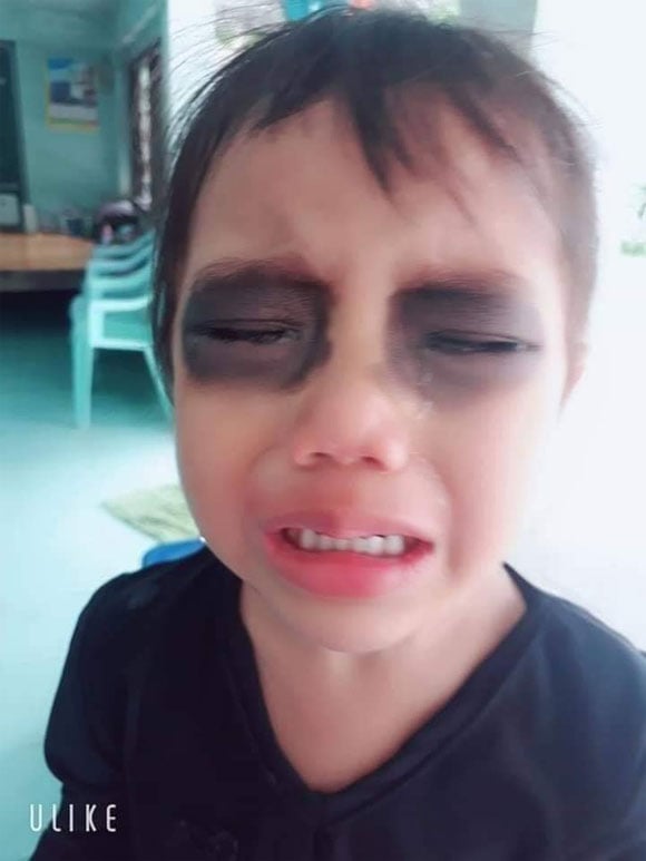 Bé gái khóc thét vì đôi mắt thâm đen sau 1 đêm.