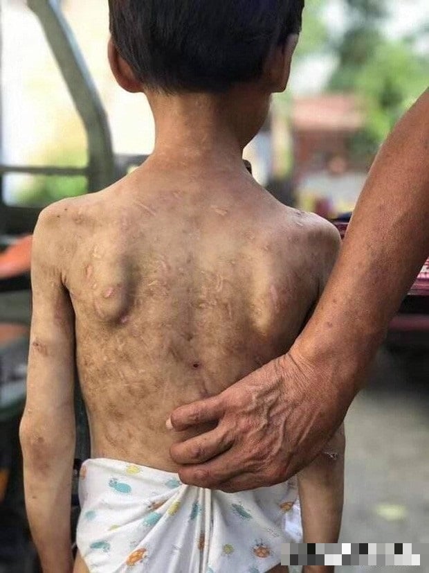 Những vết sẹo chi chít trên lưng bé gái.