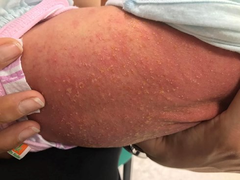 Em bé viêm da do bà nội cho nằm than tổ ong