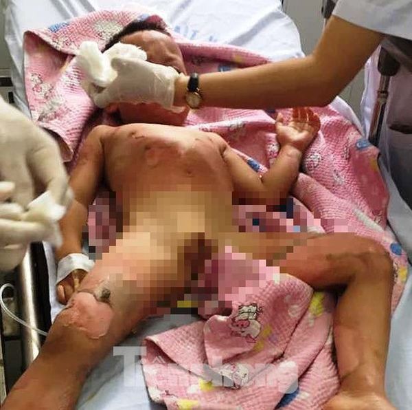 Cháu bé bị bỏng nặng đang được điều trị tại bệnh viện. Ảnh: báo Tiền Phong