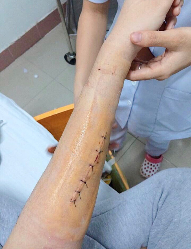 Hình ảnh được Đào Bá Lộc chia sẻ với cánh tay chằng chịt vết khâu.