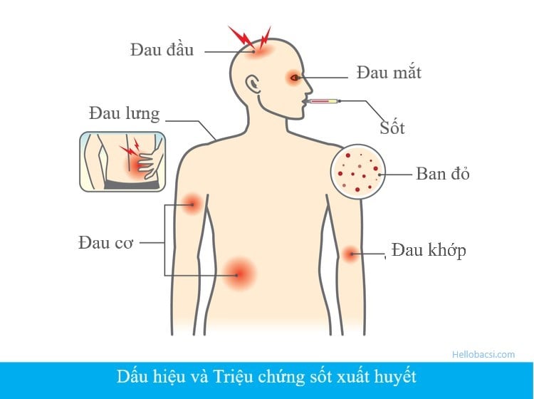 trieu-chung-sot-xuat-huyet-1