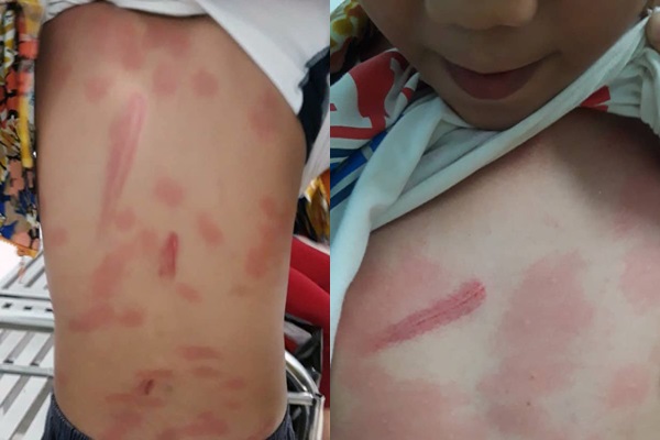 Bé trai bị cô ruột bạo hành thương tích khắp người.