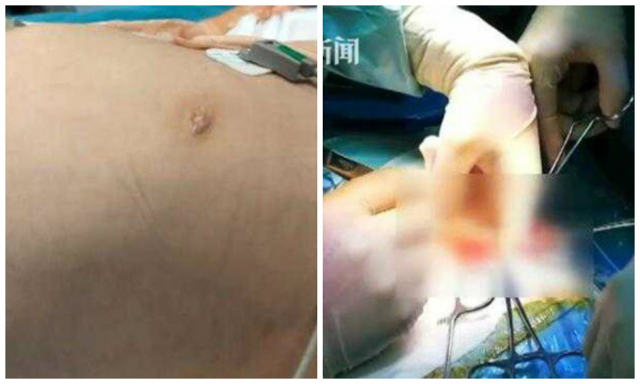 Bé 4 tuổi bụng phình to như có bầu
