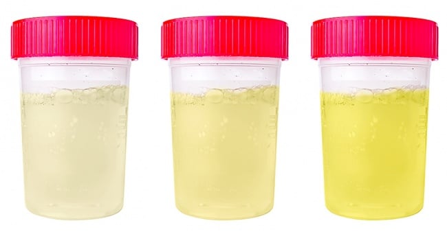Màu nước tiểu nói lên tình trạng sức khỏe của trẻ