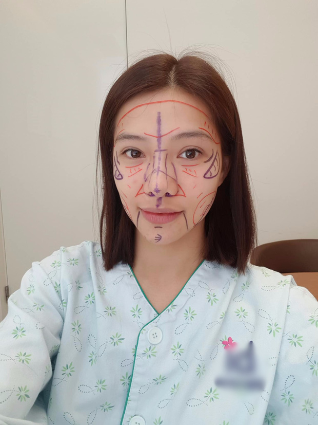 Lưu Đê Ly trước khi lên bàn Shbet888 tiền thưởng cực khủng thẩm mỹ tại Hàn Quốc.