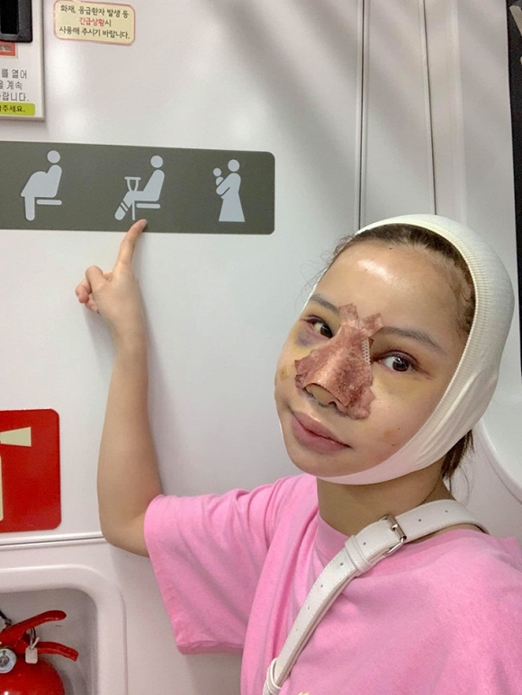 Gương mặt sưng phù của Lưu Đê Ly sau Shbet888 tiền thưởng cực khủng thẩm mỹ.