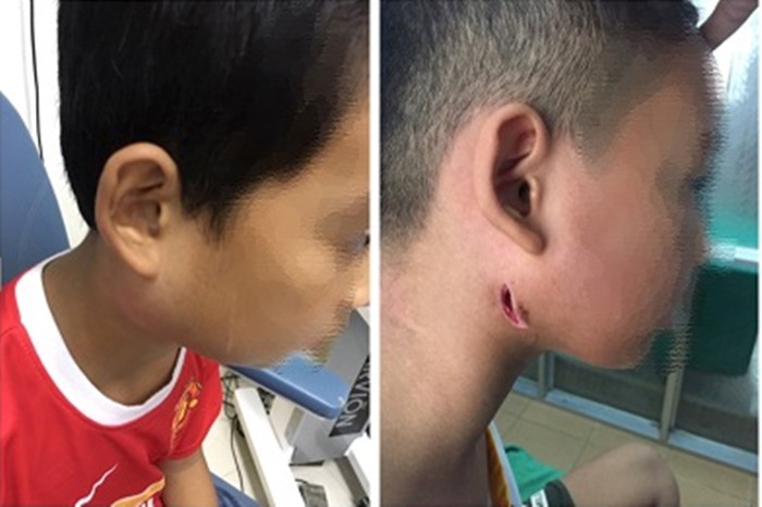 Hai trong số 3 bệnh nhi ở Nghệ An được chẩn đoán bị nhiễm vi khuẩn ăn thịt người.
