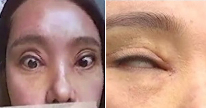 Cô gái không thể nhắm mắt sau khi Shbet888 tiền thưởng cực khủng cắt mí.