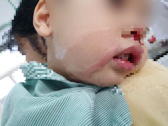 Bệnh nhi bị mẹ nhỏ nhầm axit vào mũi gây bỏng nặng.