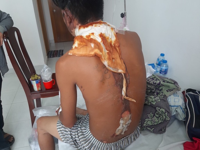 Toàn bộ phần lưng của thanh niên này bị bỏng nặng. Ảnh: A.Minh.