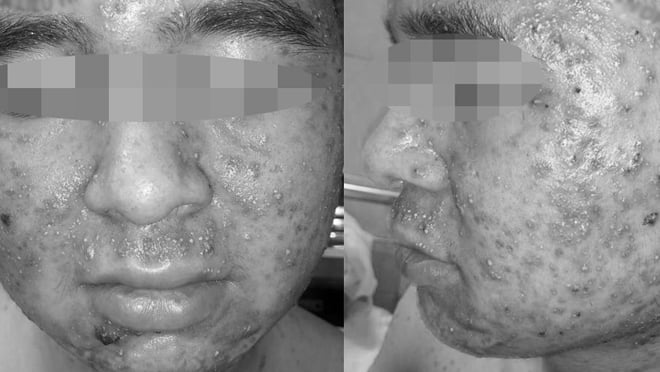 Mụn trứng cá nổi khắp mặt sau khi bệnh nhân sử dụng thuốc mua trên mạng. (Ảnh: BV Da liễu Trung ương)