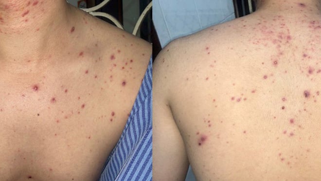 Ngoài mặt, mụn trứng cá còn xuất hiện chi chít ở trên Sh88bet đăng ký miễn phí.