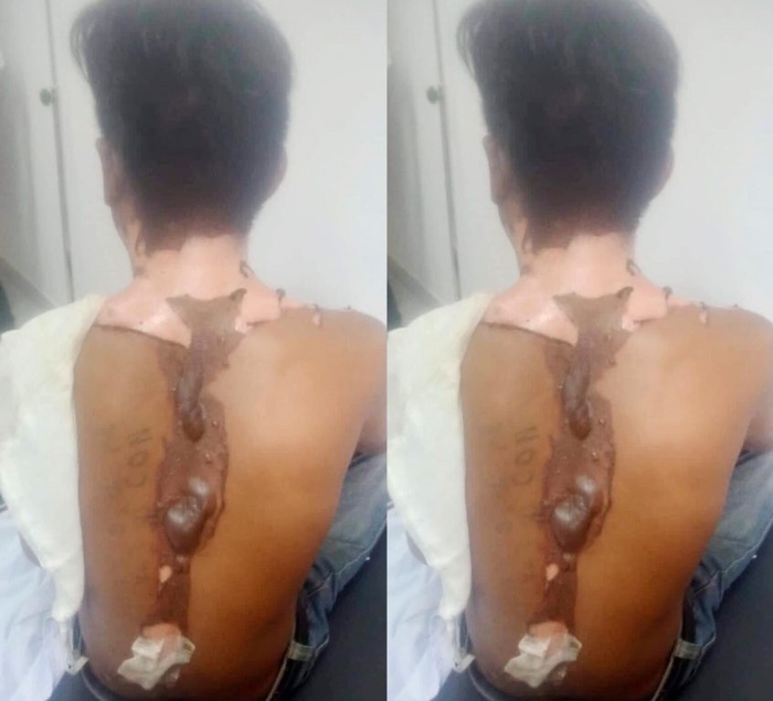 Anh Lý Phước H. đang được điều trị tại bệnh viện.
