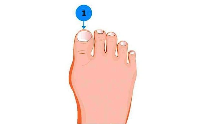 Người sở hữu ngón chân cái to
